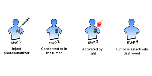 Photodynamic therapy (PDT)